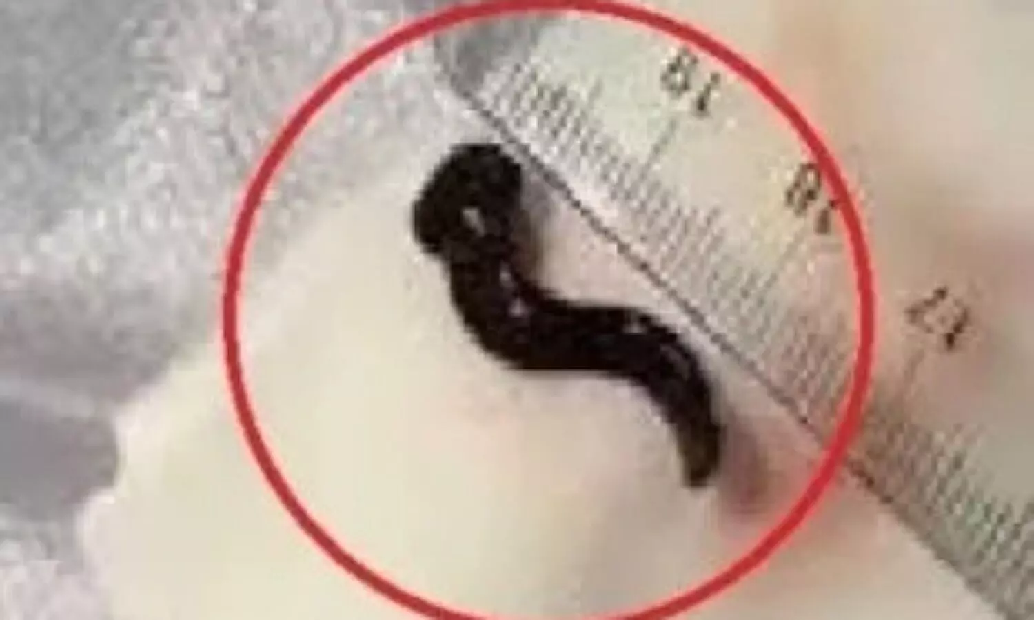 2 leeches came out of china man ear