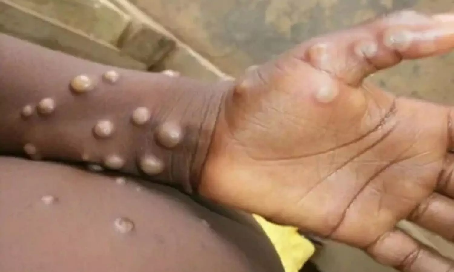 symptoms and causes of monkeypox