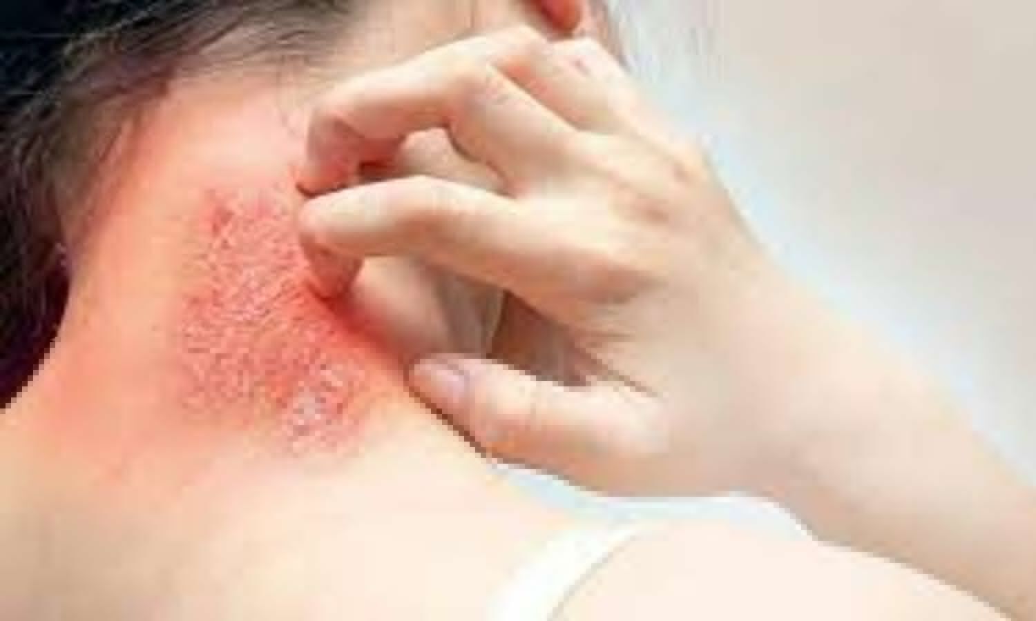 Fungal Infection Ko Jad Se Kaise Khatam Kare: These home remedies are a panacea for fungal infection.  1 News Track English