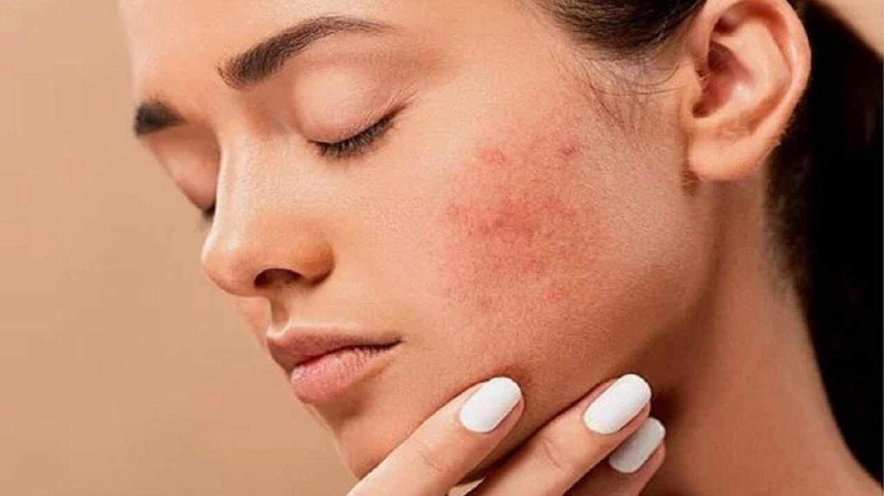 Pimples Hatane ke tips : Health news in hindi today | Pimples Treatment |  honey face pack | Pimples Hatane ke tips: पिंपल्स या दाग धब्बे से हैं  परेशान, तो अपनाएं ये