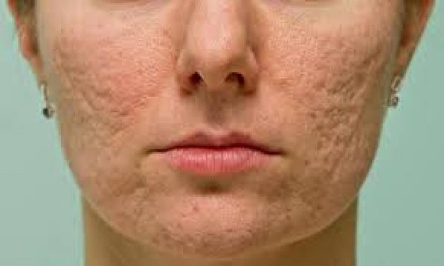 Pimple ke gadde bharne ka upay: If you are troubled by the pits caused by pimples, then follow these tips.  1 News Track English