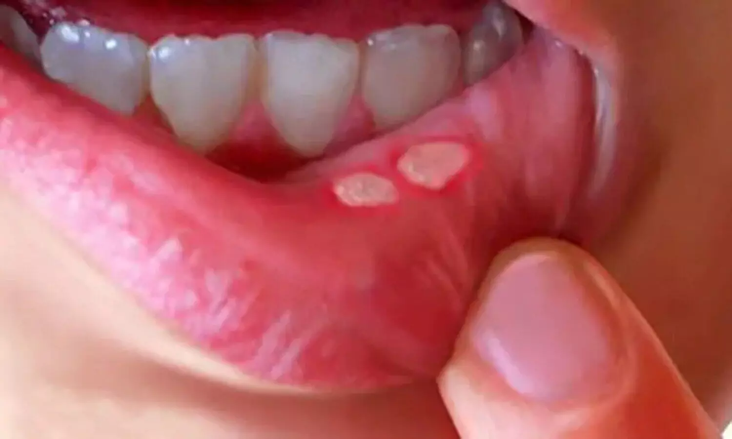 Mouth Ulcer Home Remedies: मुंह के छालों के लिए रामबाण इलाज, ट्राई करें ये घरेलू नुस्खे