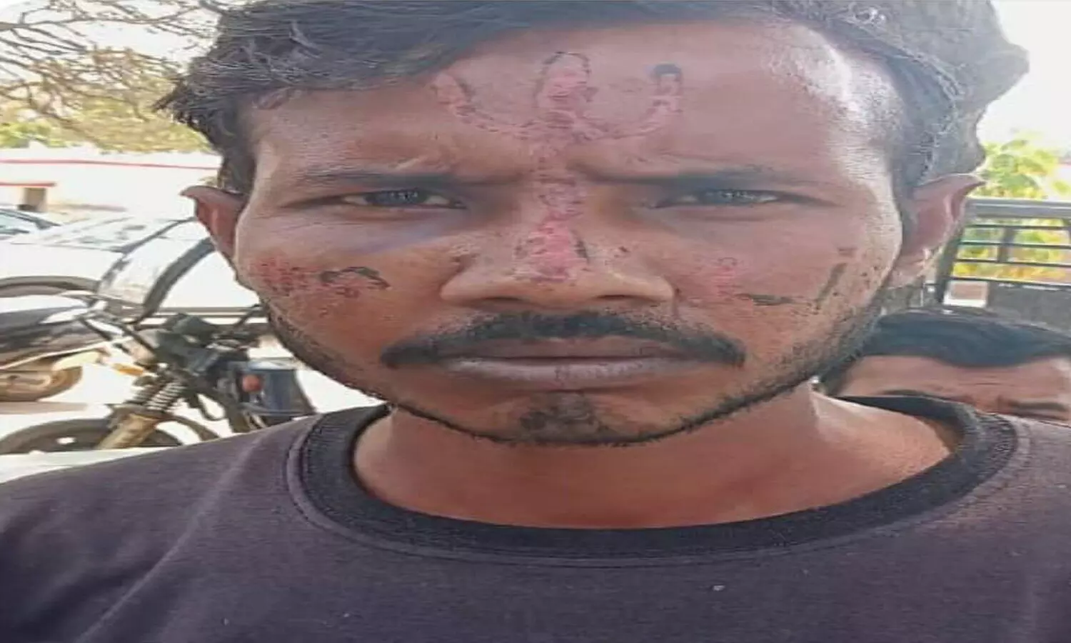 Saharanpur: युवक के चेहरे पर एसिड से बनाया गया त्रिशूल, पुलिस ने किया मामले का खुलासा