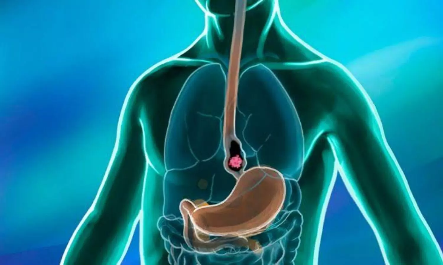 Esophageal cancer symptoms