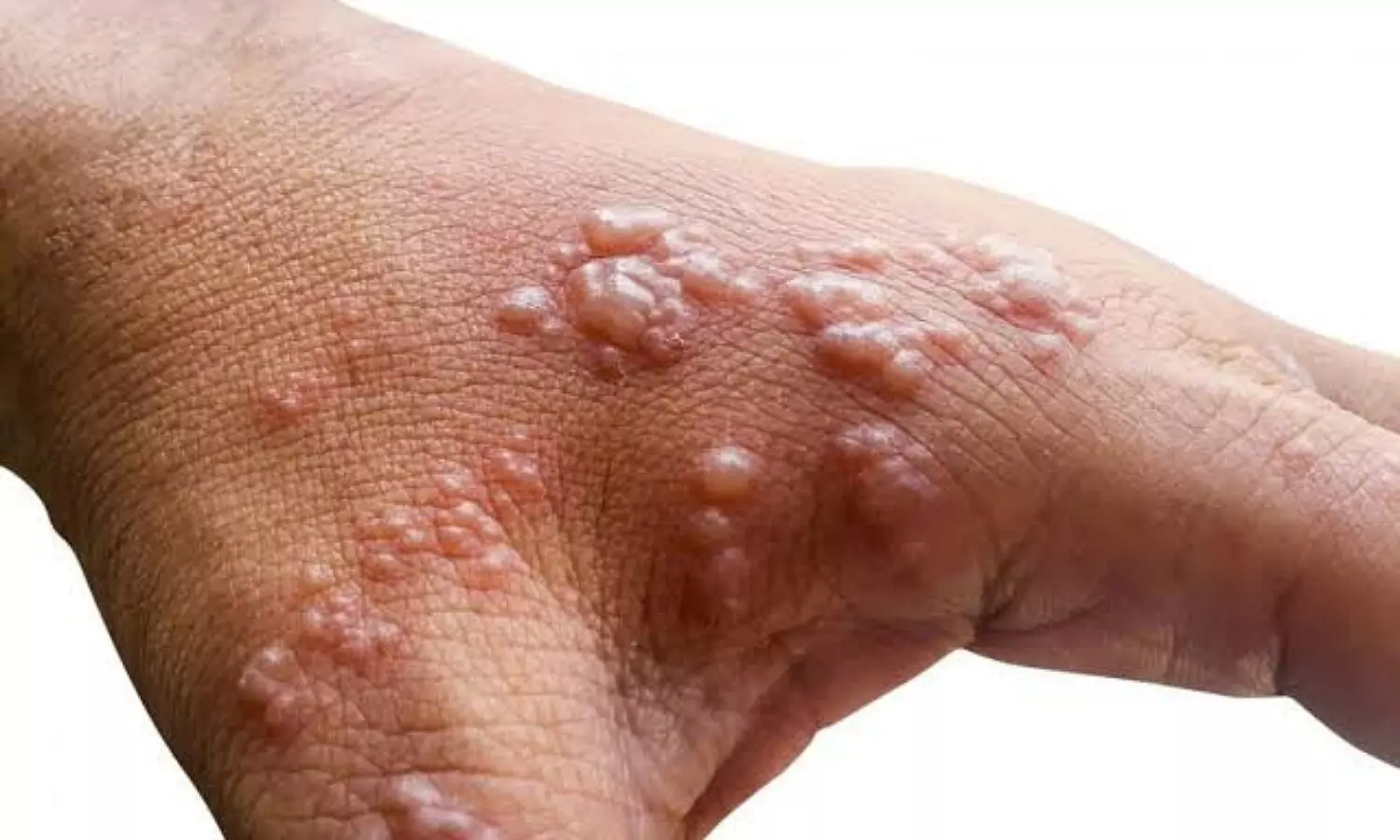 Monkeypox Virus treatment