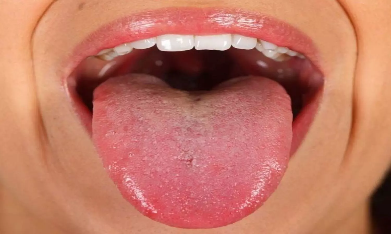Tongue and bacteria