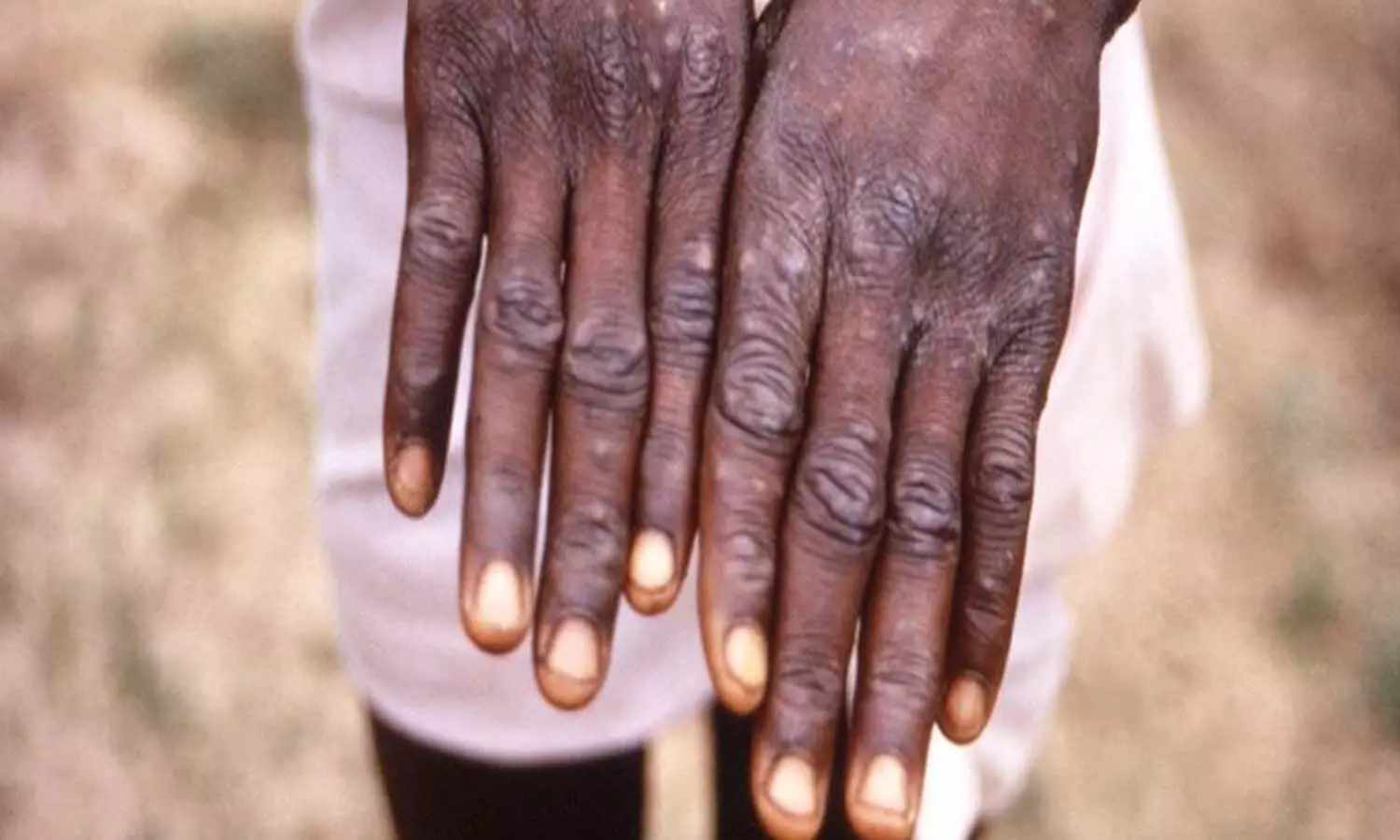 Monkeypox In Isreal: First case of monkeypox confirmed in Israel, man came from Western Europe