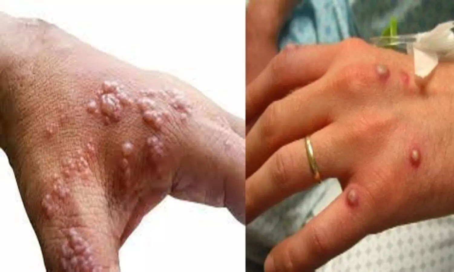 Monkeypox Virus and India