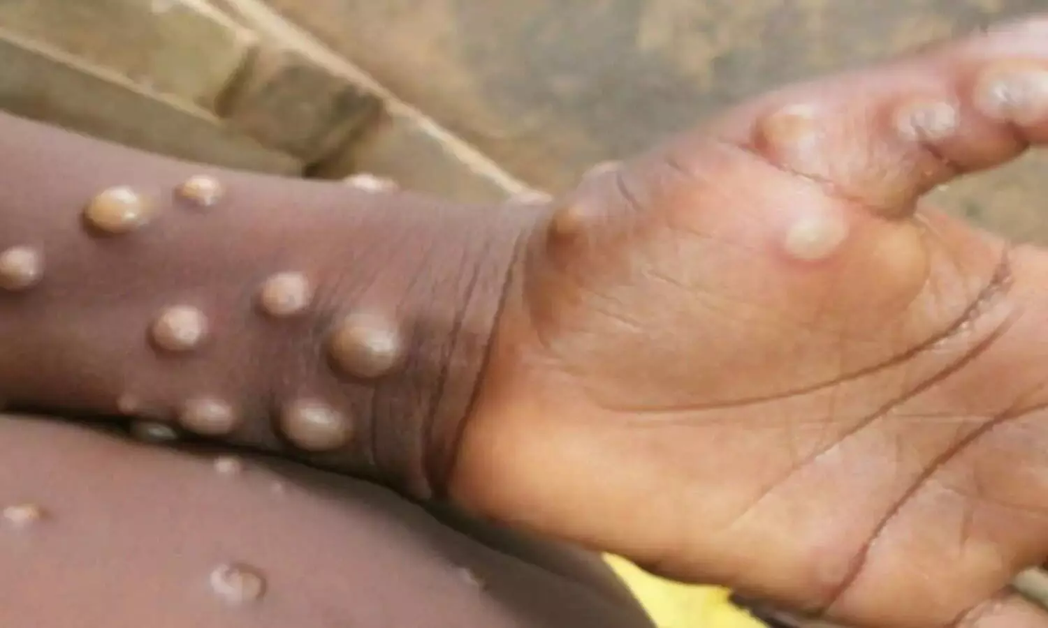 Monkeypox virus