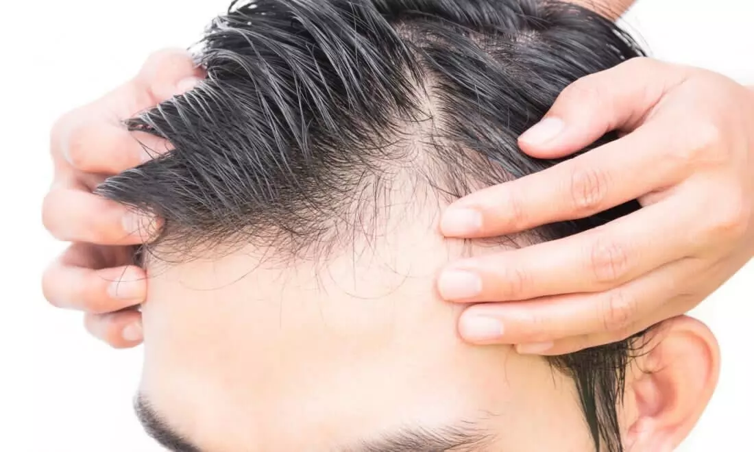 Hair Loss In Men