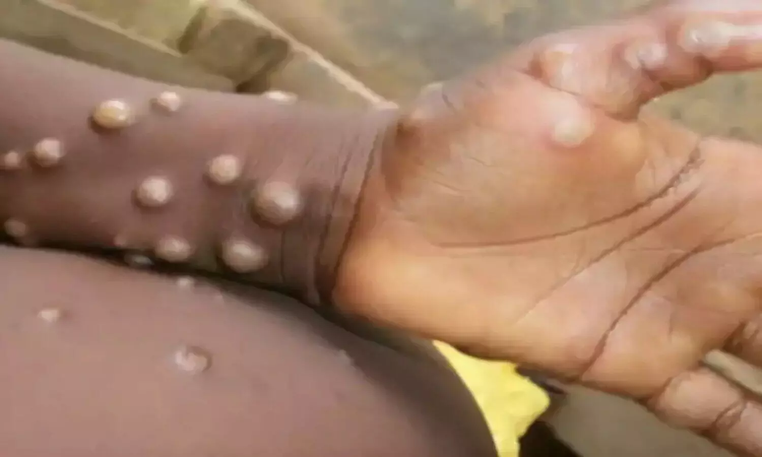 Monkeypox Death in India