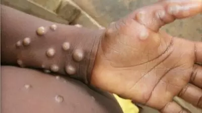 union health ministry issues new guidelines to states and uts on management of monkeypox disease