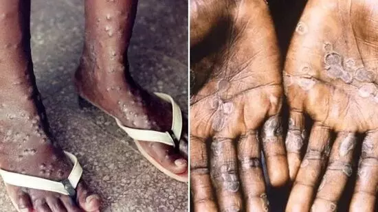 multi country monkeypox outbreak 1100 cases have been reported in world