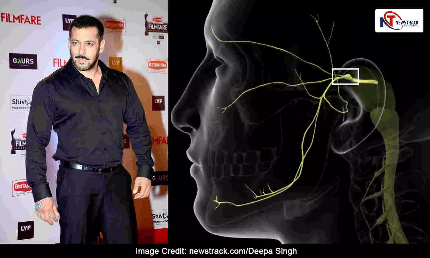 Salman khan suffering from Trigeminal Neuralgia