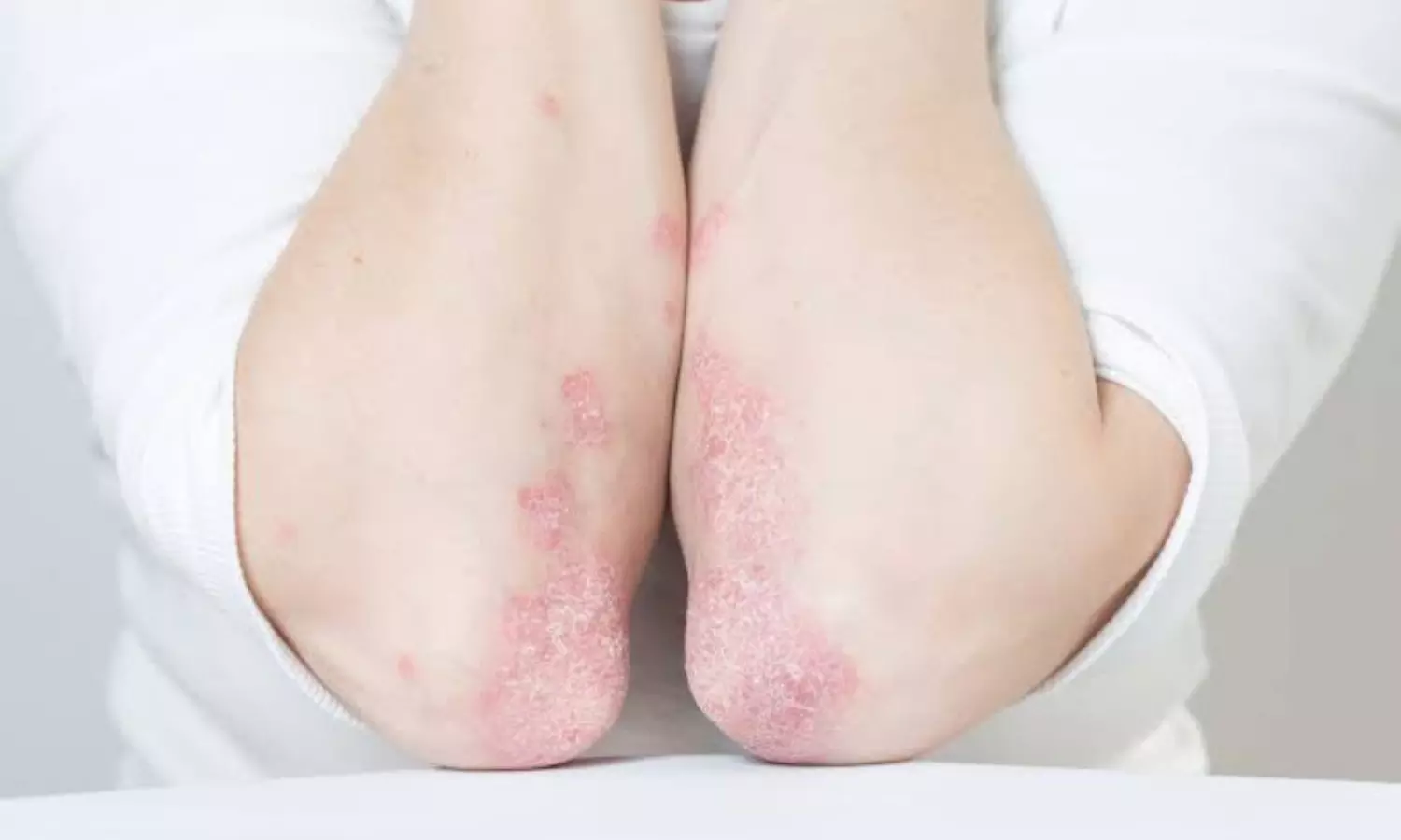Psoriasis Treatment and Tips