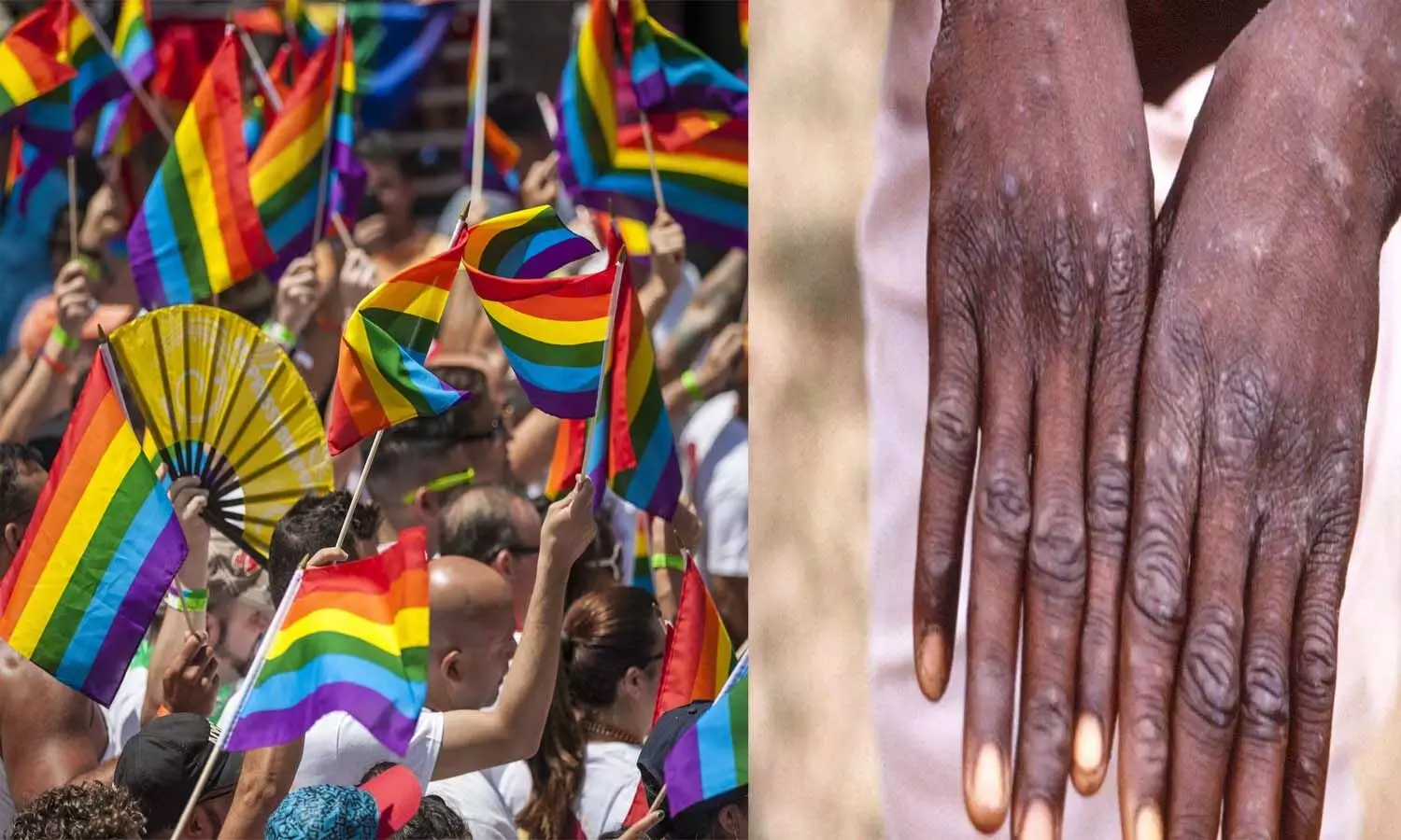 Why is there outrage in the LGBTQ community over monkeypox?