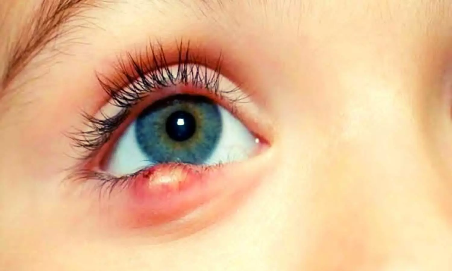 Bilni in Eyes  Treatment