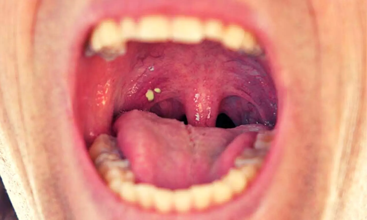 Remedies for Tonsil Relief