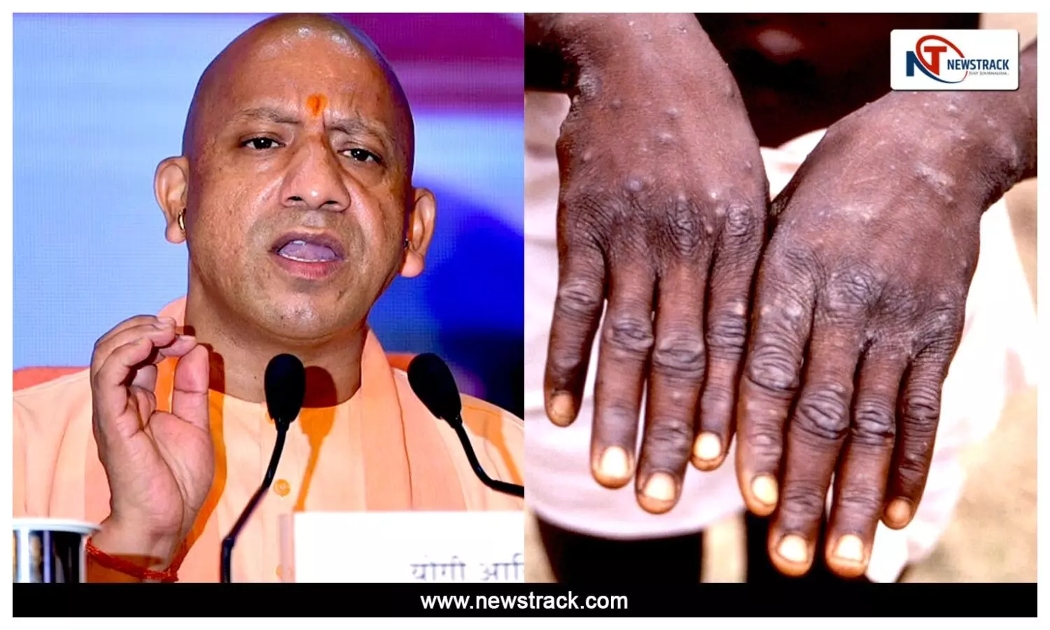 Yogi Action on Monkeypox