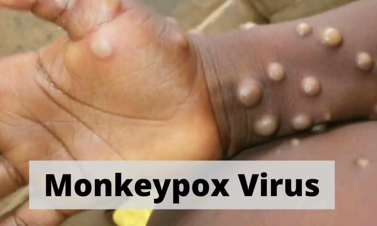 Monkeypox