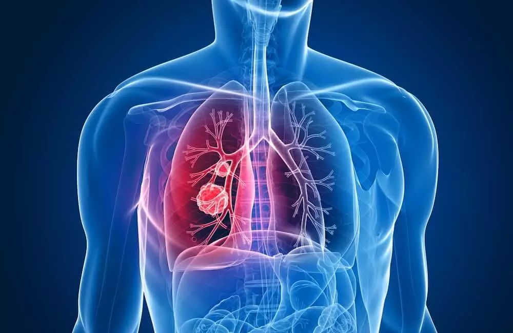 Treatment and Symptoms of Lung Cancer