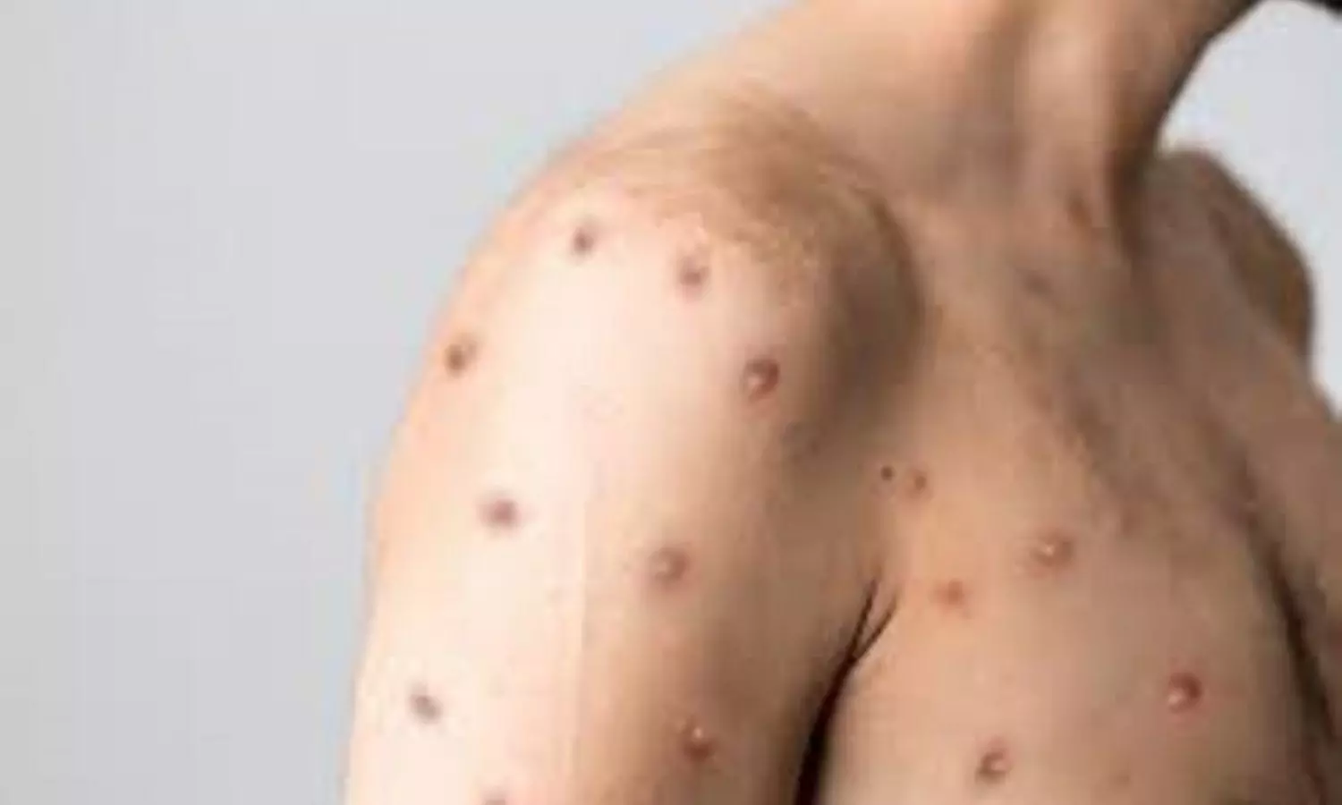 Monkeypox Treatment and Prevention