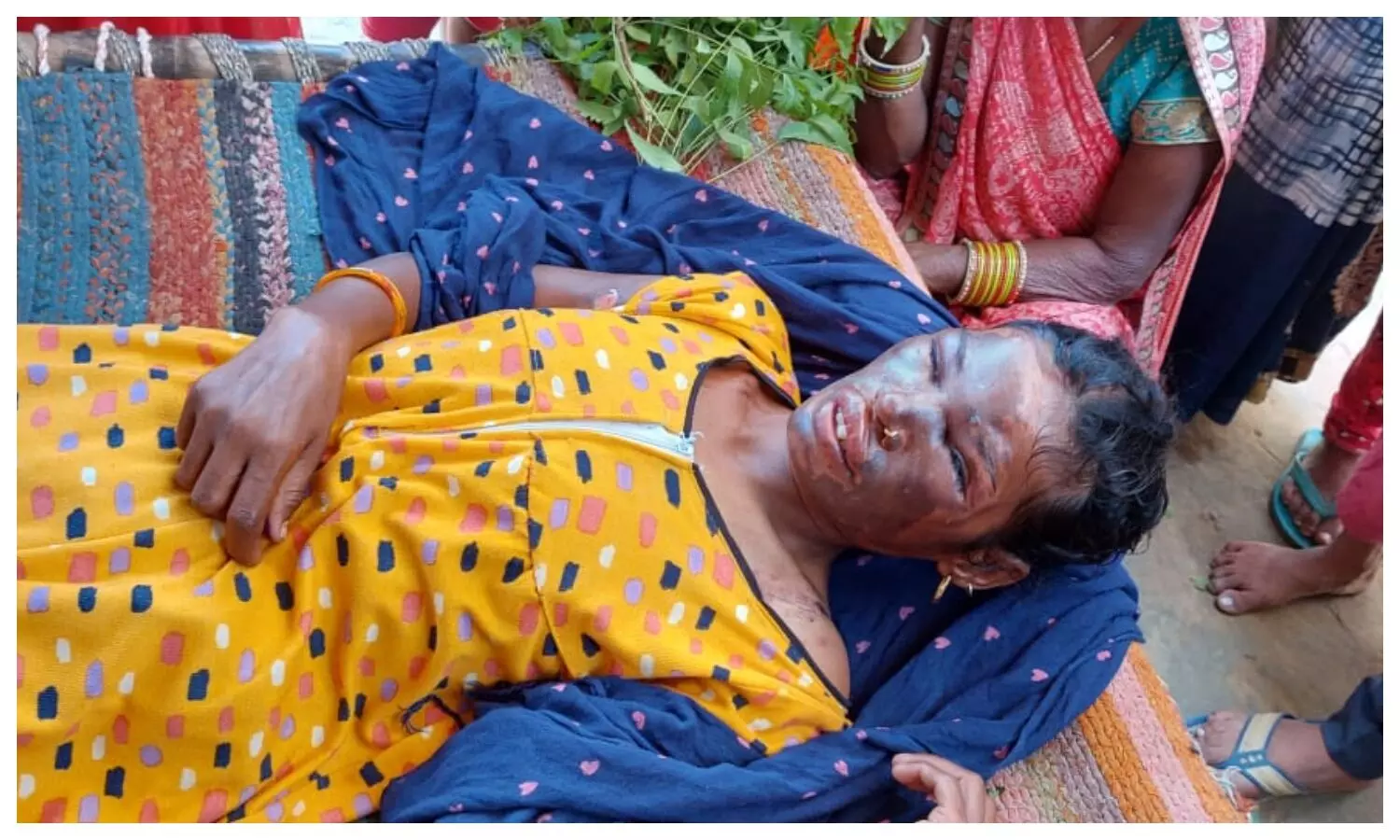 Acid attack on woman in Hathras