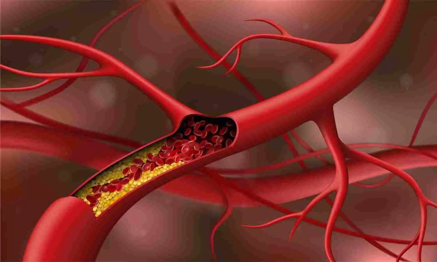 Cholesterol Control