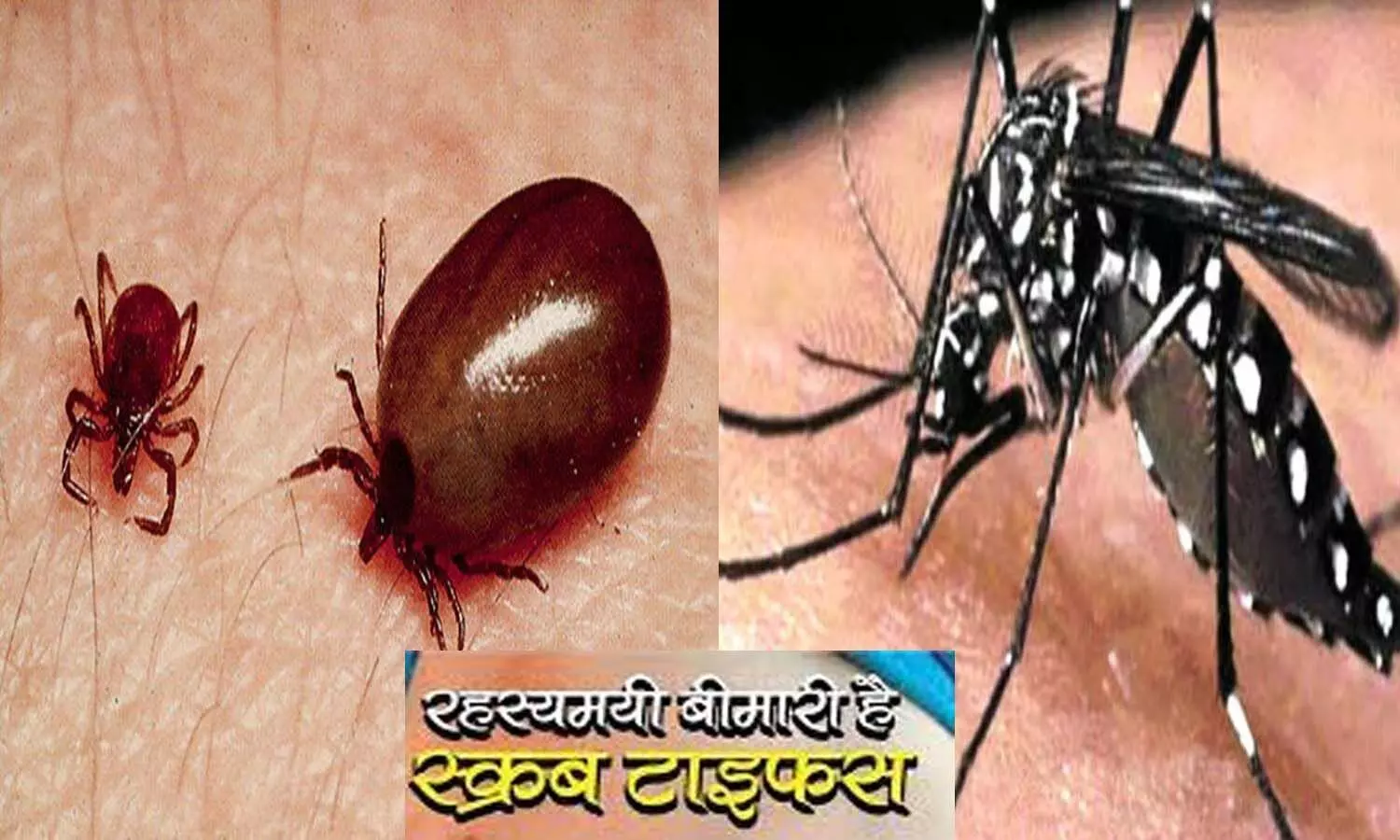Cases of scrub typhus found with dengue-malaria, experts said - do not take antibiotics in every fever