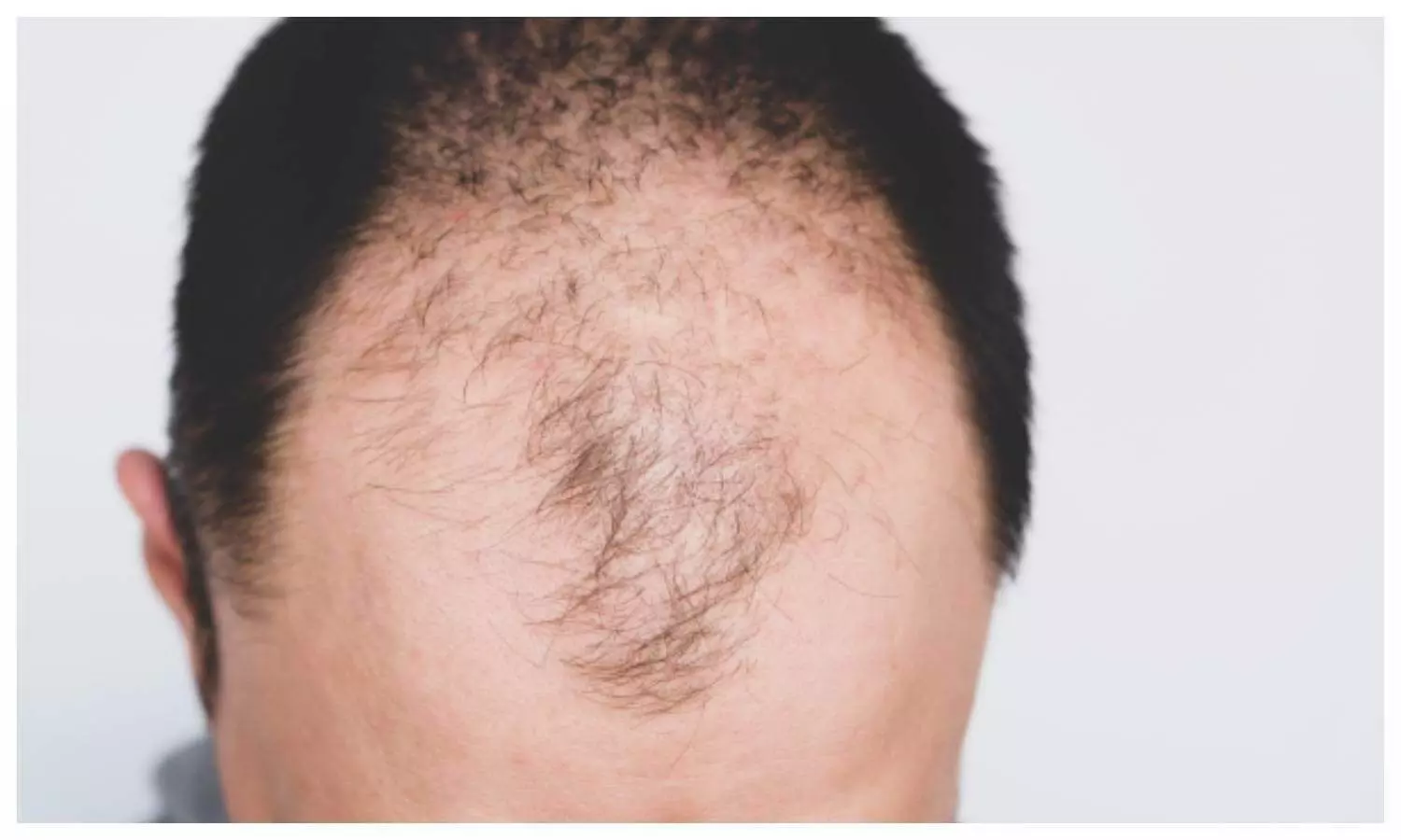 Hair Loss in Men