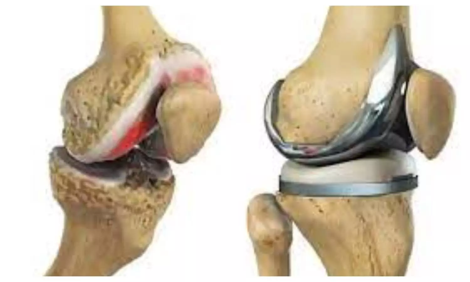 knee Replacement Surgery