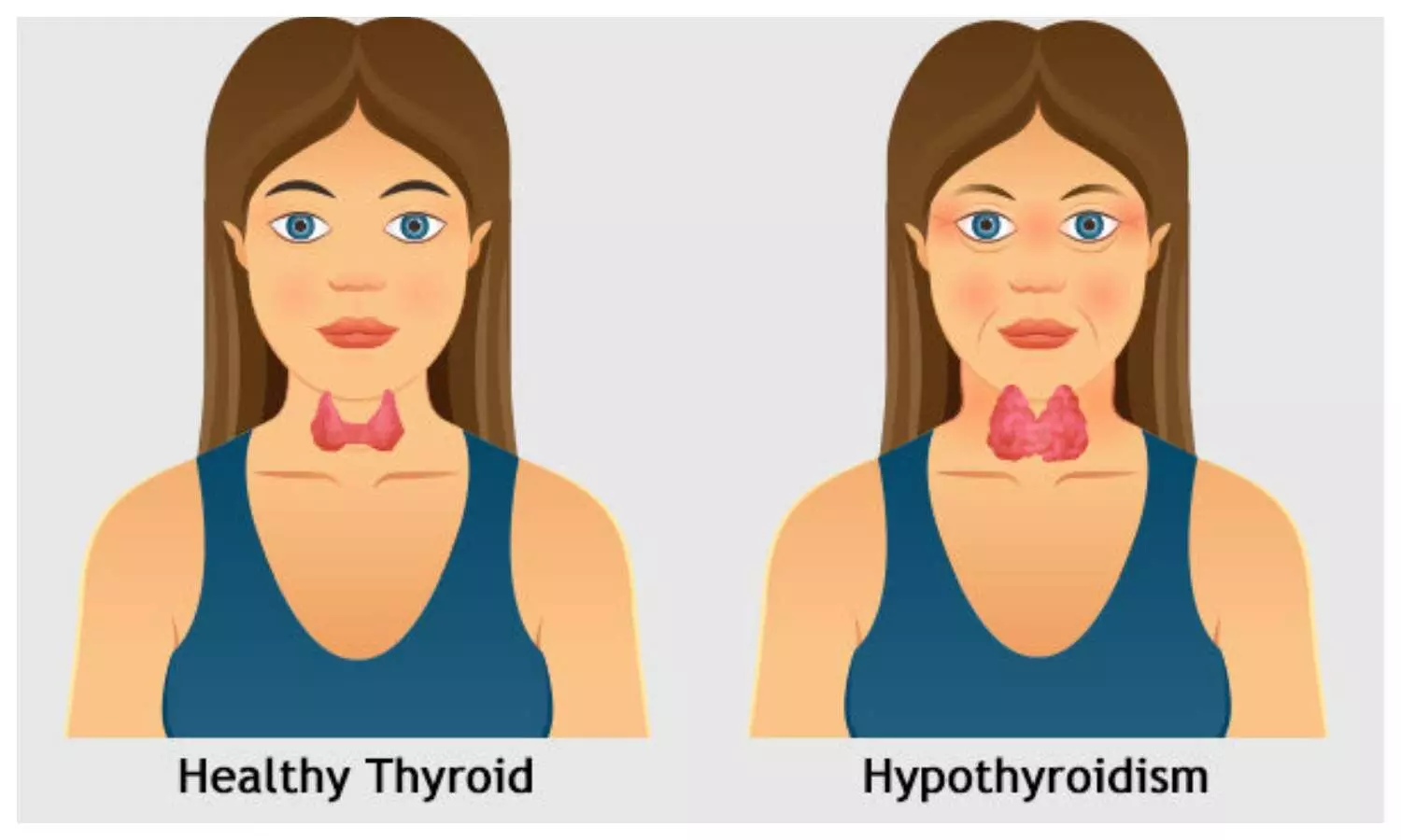 Hypothyroidism Symptoms on Face