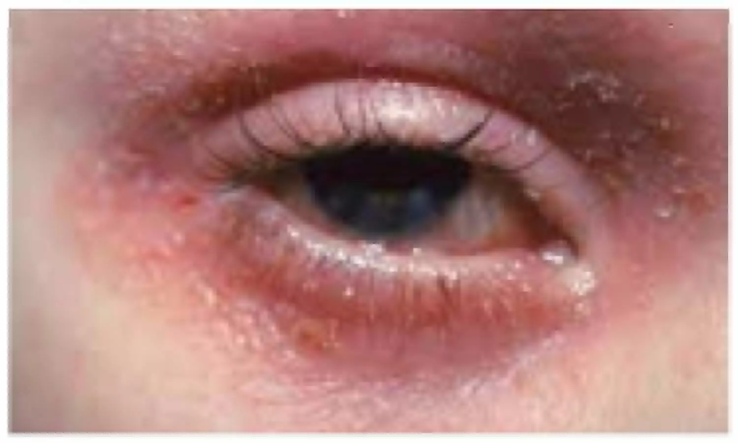 Eye eczema