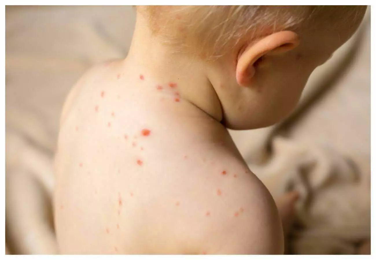Measles in kids