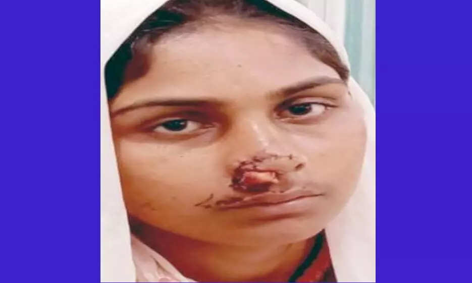 Drunken husband strange act of chopping off wife nose in Moradabad