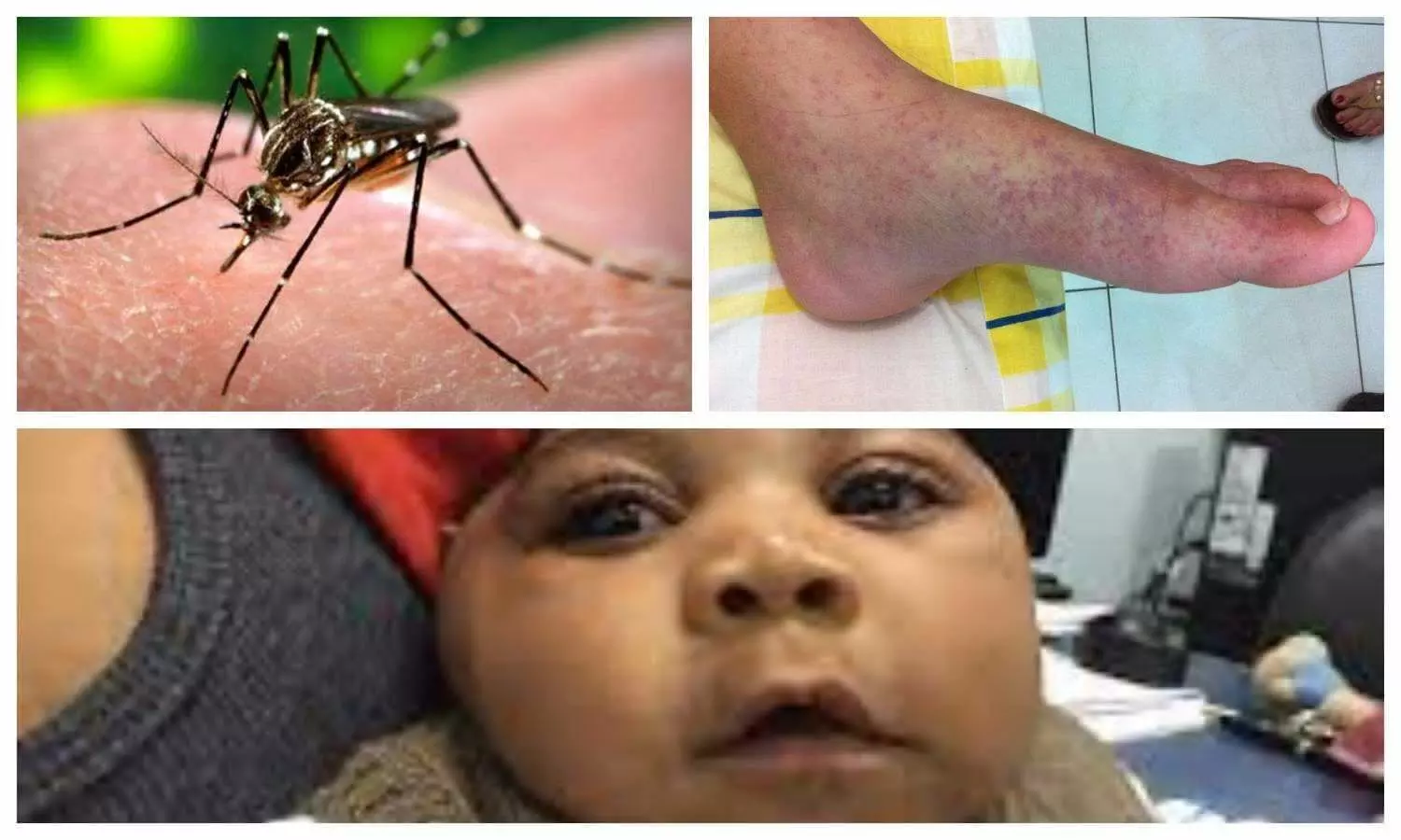 Zika virus, dengue and chikungunya