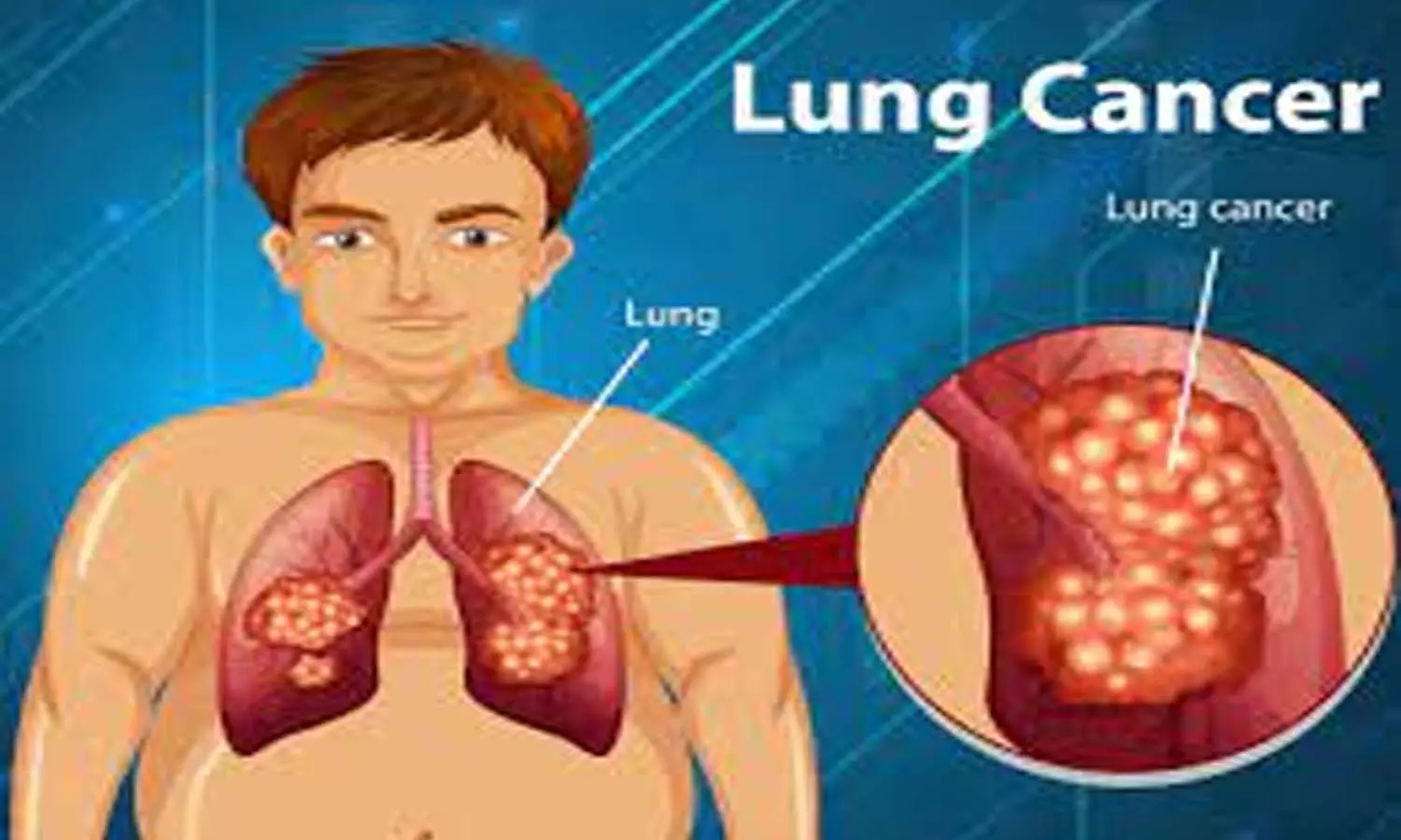Attention ! Lung cancer cases increased by five percent in two years