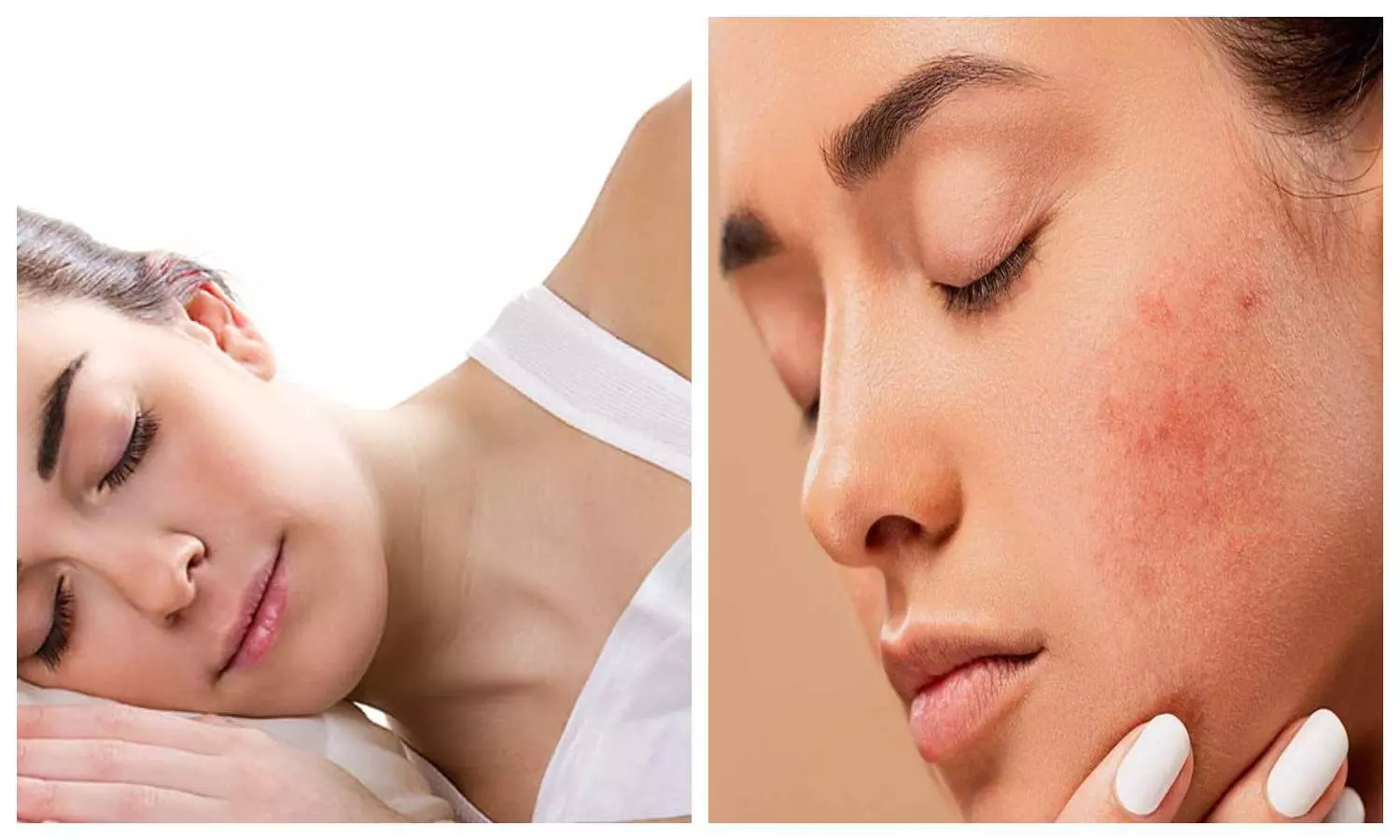 Sleeping Mistakes Trigger Pimples
