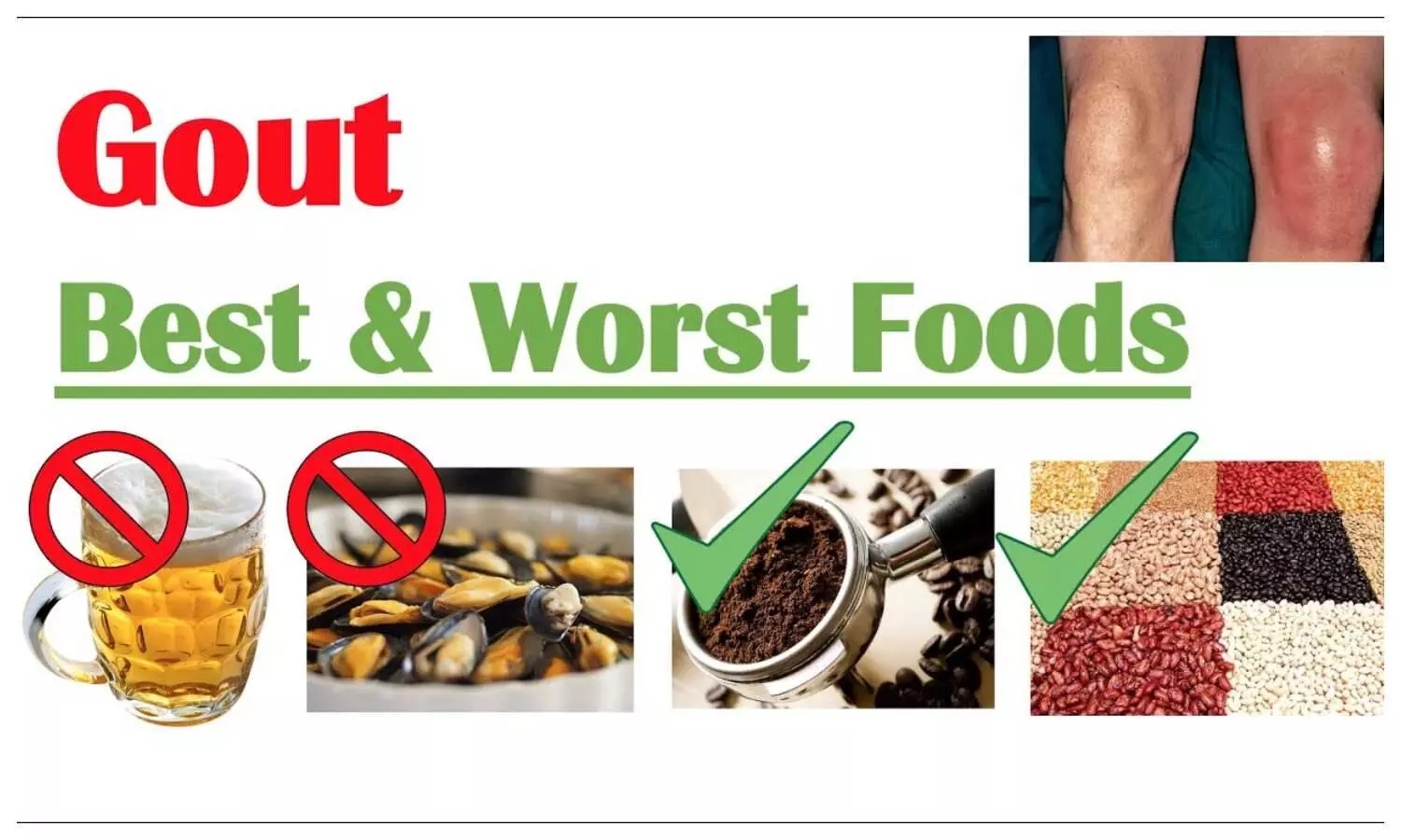 Foods to Avoid in Gout