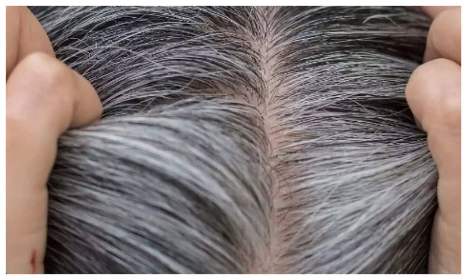 Ayurvedic Remedies For Gray Hair