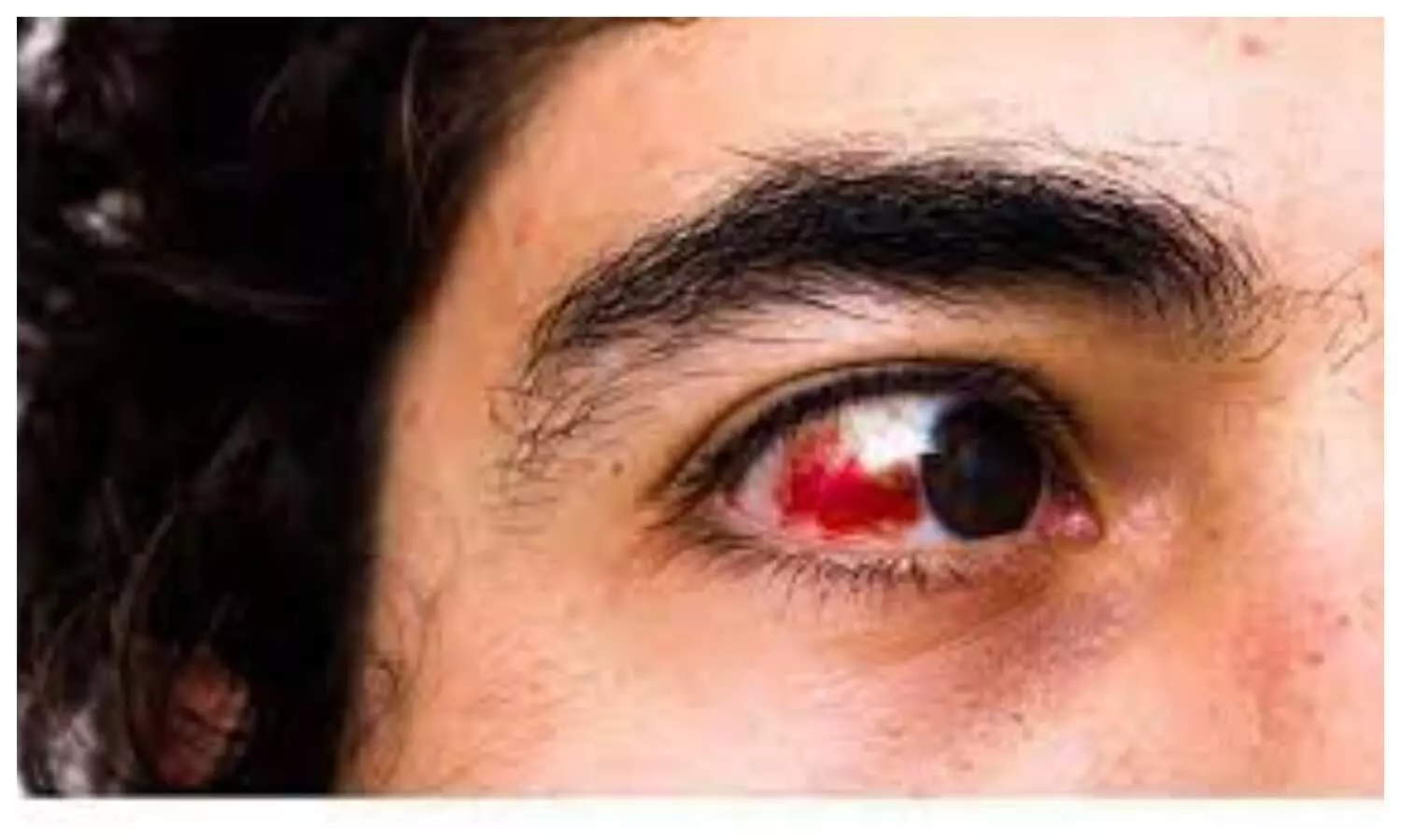 Red Eyes Side Effects