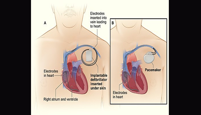 दिल के रोगियों की अचानक मौत का खतरा दूर करता है आईसीडी