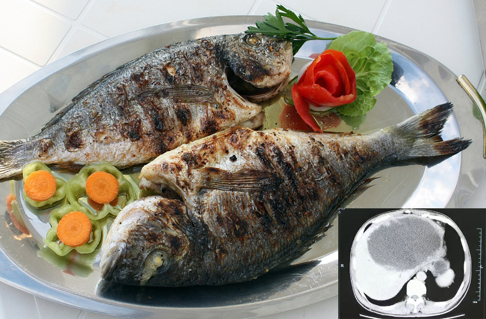 मछली खाना पड़ गया भारी: पेट में निकले करोड़ों अंडे, डॉक्टर भी हुए हैरान
